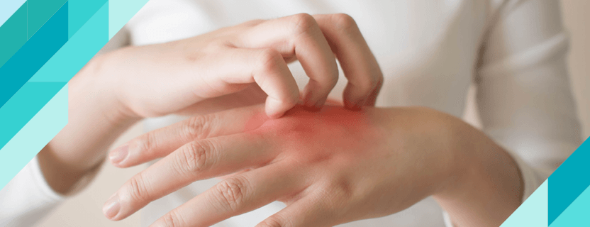Sedef Hastalığı Nedir? Sedef Hastalığı Tedavisi Nedir?