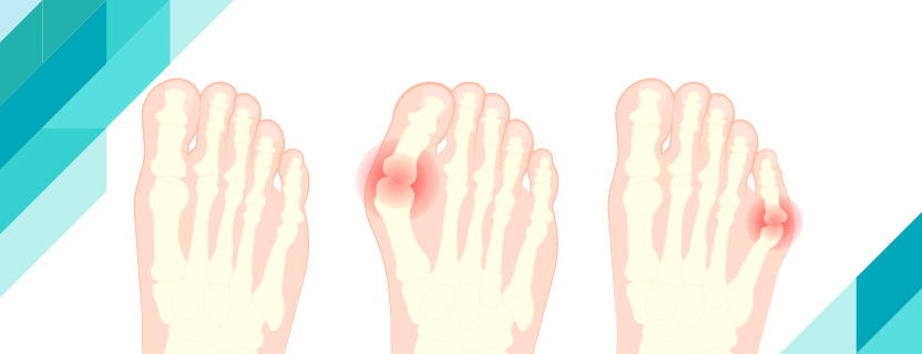 Halluks Valgus Nedir?