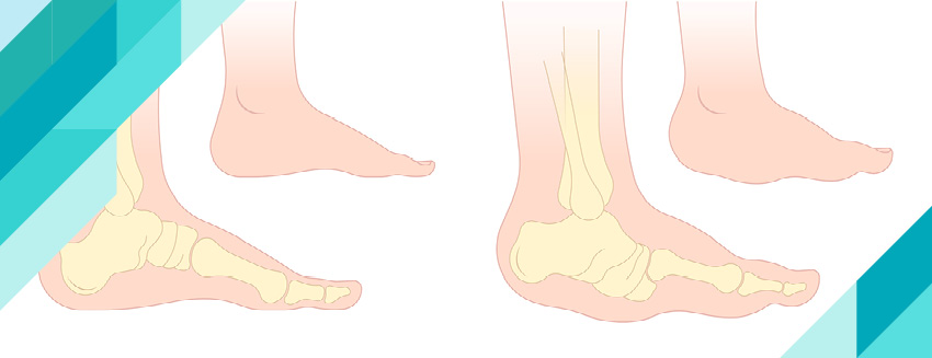 Charcot Marie Tooth Hastalığı Nedir?