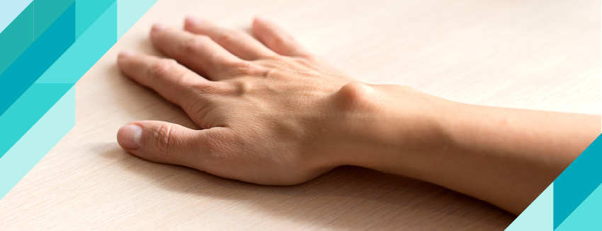 Ganglion (El Bileği Kisti) Nedir?