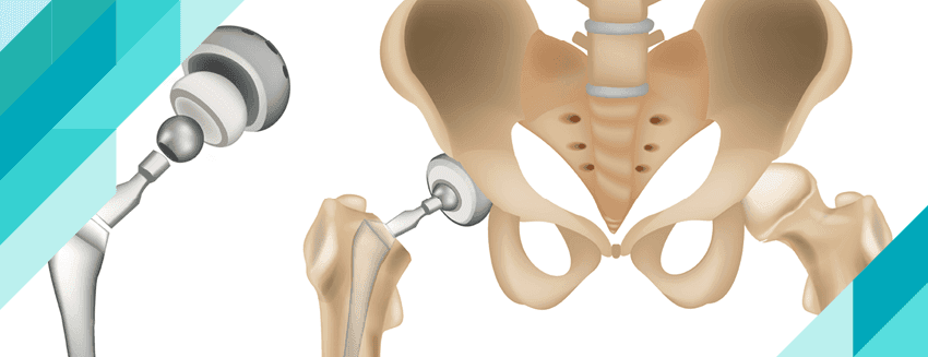 What is Total Hip Replacement Surgery?