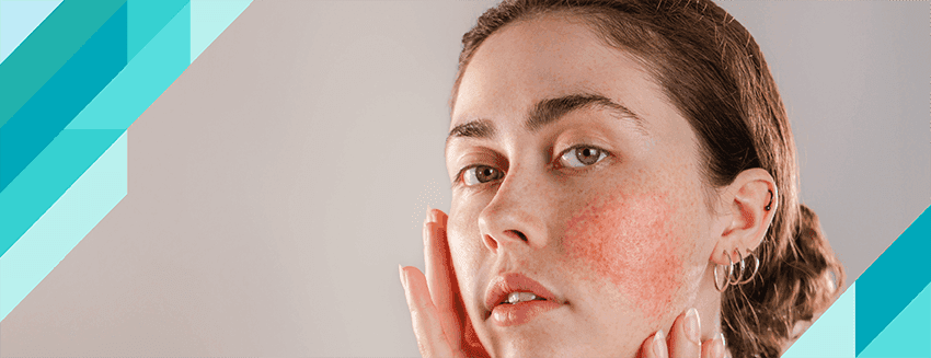 What is Rosacea (Rose Disease)?
