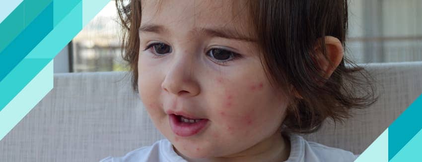 What is Measles? What are the Symptoms?