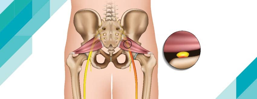 What is Piriformis Syndrome?