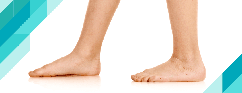Flatfoot and Treatment in Children
